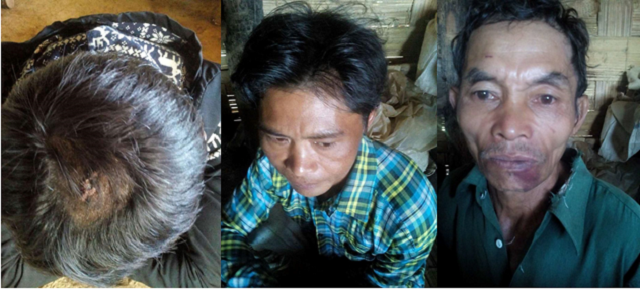 Photo SHRF: three victim villagers who were beaten by Burmese army.