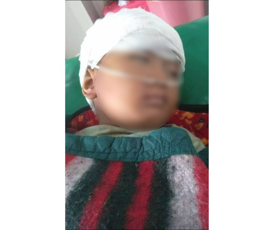 A child wounded by shelling in Kutkai township Shan State