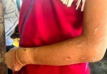 Water Shortage Triggers Skin Disease Outbreak in Demoso IDP Camps Children in Demoso IDP camps suffer from water related skin diseases