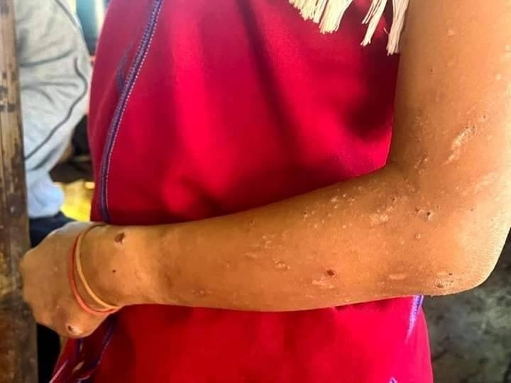 Children in Demoso IDP camps suffer from water related skin diseases Children in Demoso IDP camps suffer from water related skin diseases